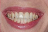 Unrestricted and full smileseveral years after treatment.