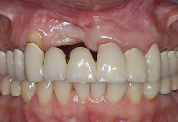 Unaesthetic anterior dental bridge due to deficits in bone and soft tissue